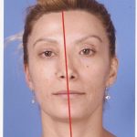 Rhinoplasty Before & After Patient #2190