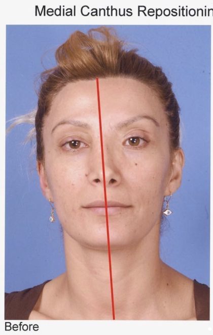 Rhinoplasty Before & After Patient #2190