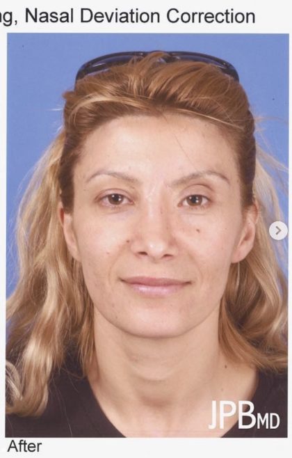 Rhinoplasty Before & After Patient #2190