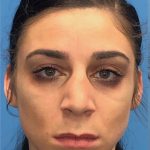 Rhinoplasty Before & After Patient #2180