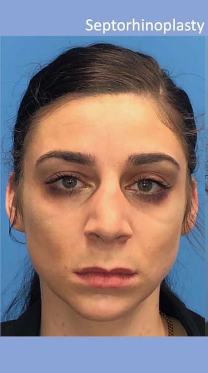 Rhinoplasty Before & After Patient #2180