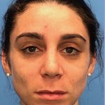 Rhinoplasty Before & After Patient #2180