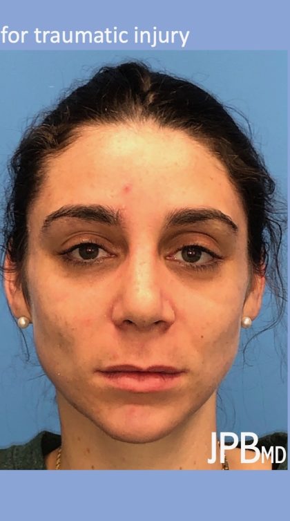 Rhinoplasty Before & After Patient #2180