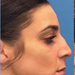 Rhinoplasty Before & After Patient #2180