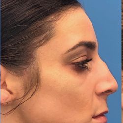 Rhinoplasty Before & After Patient #2180