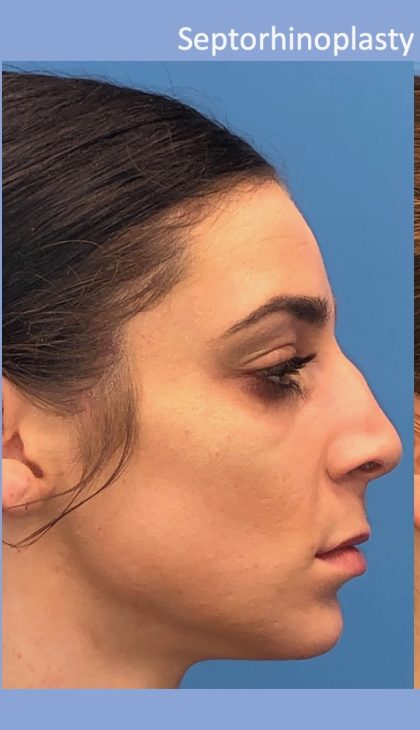 Rhinoplasty Before & After Patient #2180