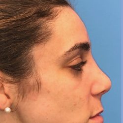 Rhinoplasty Before & After Patient #2180