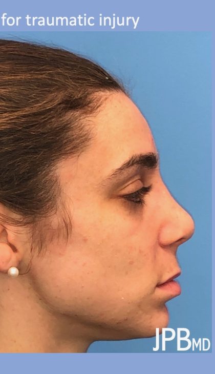 Rhinoplasty Before & After Patient #2180