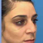 Rhinoplasty Before & After Patient #2180