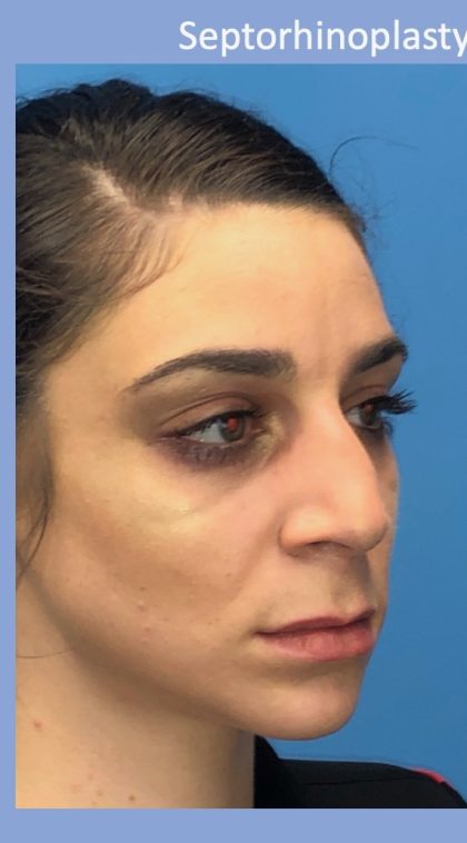 Rhinoplasty Before & After Patient #2180