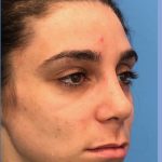 Rhinoplasty Before & After Patient #2180