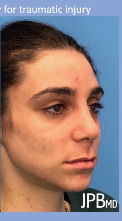 Rhinoplasty Before & After Patient #2180