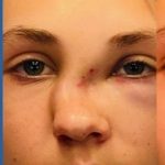 Rhinoplasty Before & After Patient #2181