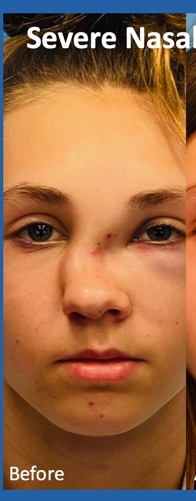 Rhinoplasty Before & After Patient #2181