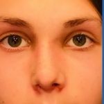 Rhinoplasty Before & After Patient #2181
