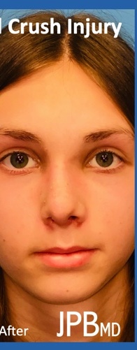 Rhinoplasty Before & After Patient #2181