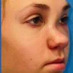 Rhinoplasty Before & After Patient #2181