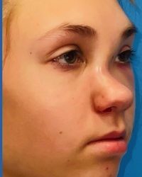 Rhinoplasty Before & After Patient #2181