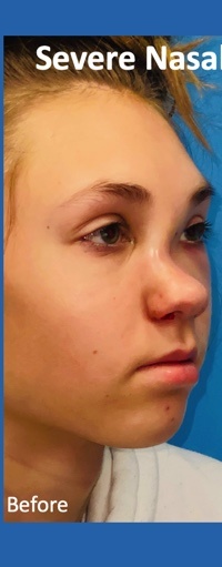 Rhinoplasty Before & After Patient #2181