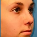 Rhinoplasty Before & After Patient #2181