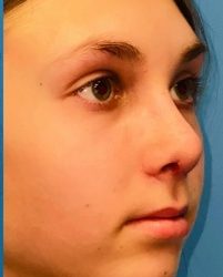 Rhinoplasty Before & After Patient #2181