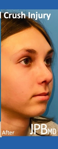 Rhinoplasty Before & After Patient #2181