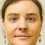 Facial Feminization Before & After Patient #876