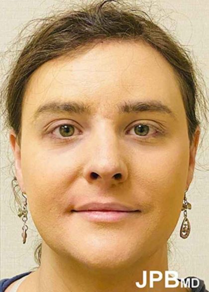 Facial Feminization Before & After Patient #876