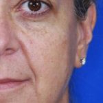 Craniofacial Before & After Patient #1176