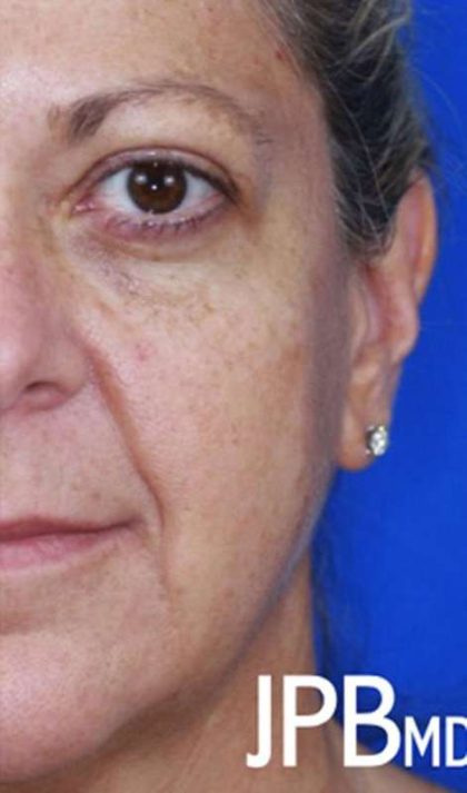 Craniofacial Before & After Patient #1176