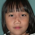 Craniofacial Before & After Patient #1182