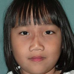 Craniofacial Before & After Patient #1182