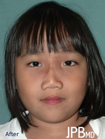 Craniofacial Before & After Patient #1182
