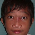 Craniofacial Before & After Patient #1191