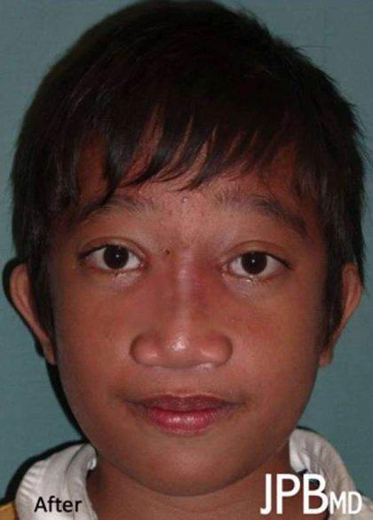 Craniofacial Before & After Patient #1191