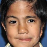Craniofacial Before & After Patient #1194