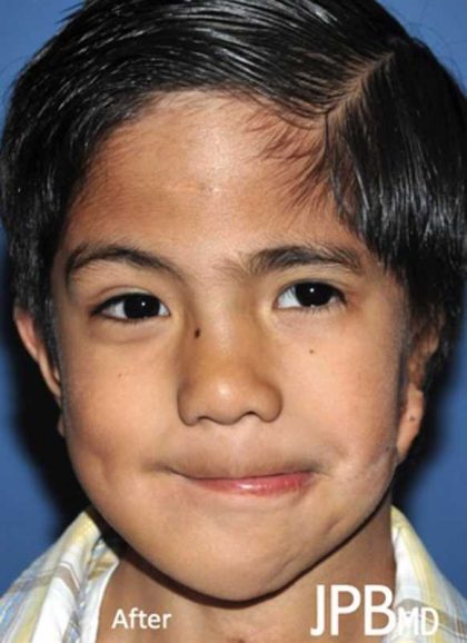 Craniofacial Before & After Patient #1194