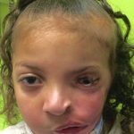 Craniofacial Before & After Patient #1197