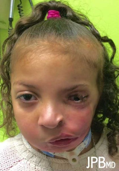 Craniofacial Before & After Patient #1197