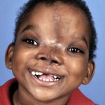Craniofacial Before & After Patient #1200