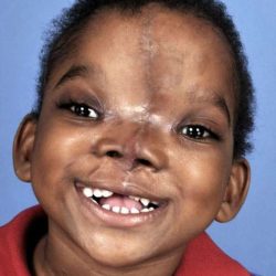 Craniofacial Before & After Patient #1200