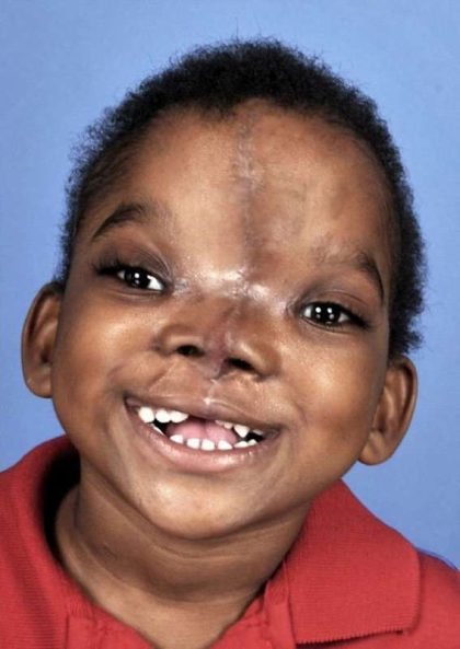 Craniofacial Before & After Patient #1200