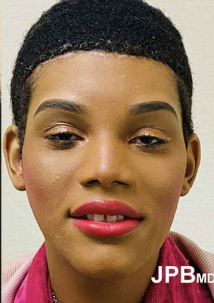 Facial Feminization Before & After Patient #906