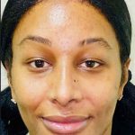 Facial Feminization Before & After Patient #912