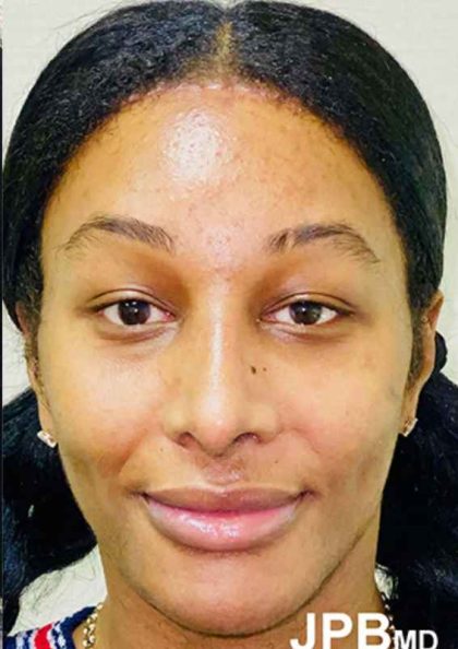 Facial Feminization Before & After Patient #912