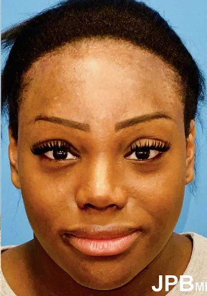 Facial Feminization Before & After Patient #918