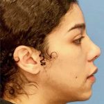 Facial Feminization Before & After Patient #924