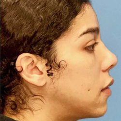 Facial Feminization Before & After Patient #924