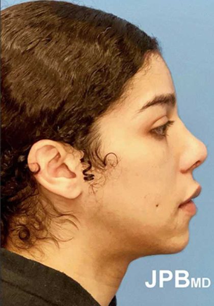 Facial Feminization Before & After Patient #924