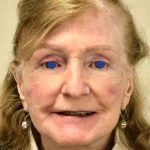 Facelift Before & After Patient #930